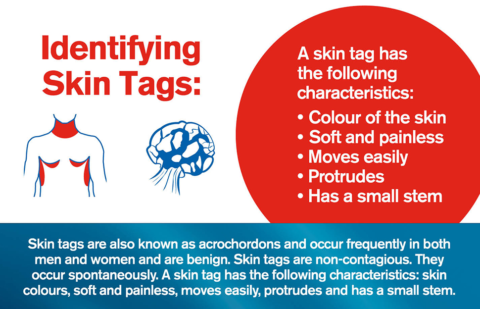 Buy Medi Freeze Skin Tag Remover Online at Chemist Warehouse®